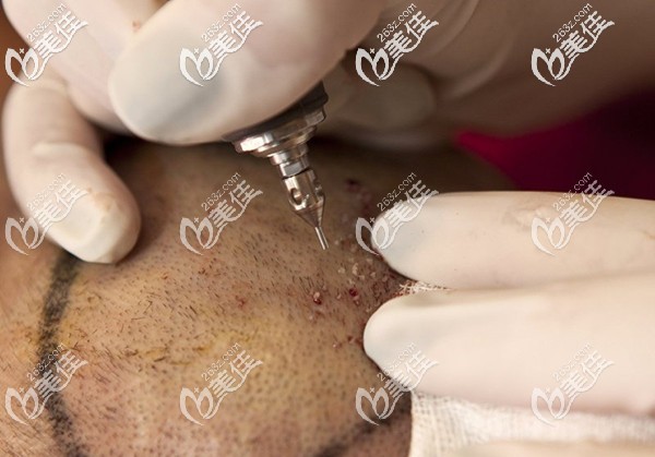 头顶发旋稀疏加密手术 头顶发旋稀疏加密手术