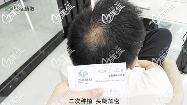 二次种植头旋加密 二次种植头旋加密