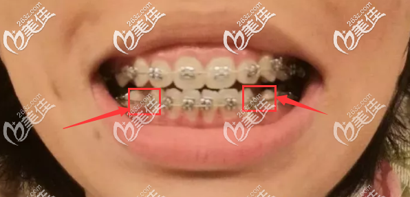 北京维乐口腔戴金属自锁托槽矫正器