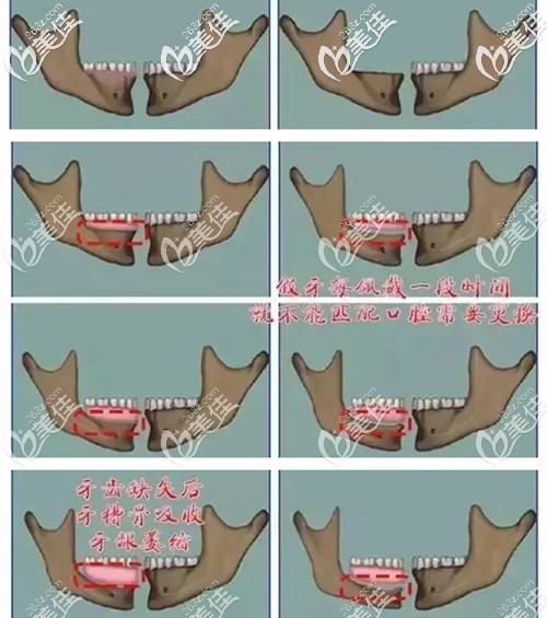 长期戴活动假牙的牙槽骨变化图