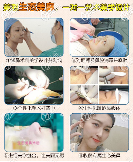 广东美恩张勇院长隆鼻手术过程案例图片 广东美恩张勇院长隆鼻手术过程案例图片
