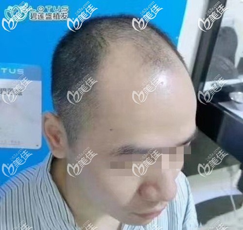 前额M型发际线脱发 前额M型发际线脱发