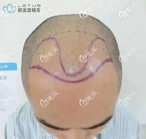 术前设计发际线种植方案 术前设计发际线种植方案
