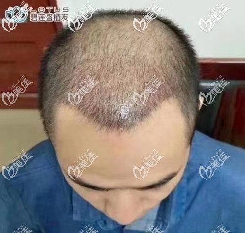 术后第四个月头发还是稀疏 术后第四个月头发还是稀疏