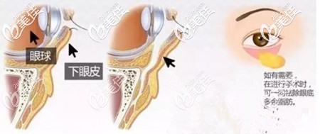 印第安纹剥离手术的原理 印第安纹剥离手术的原理