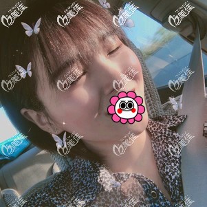 肋软骨隆鼻7天拆线后