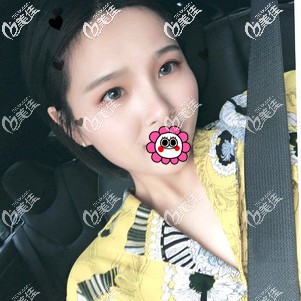 肋软骨隆鼻恢复一个月<span style=