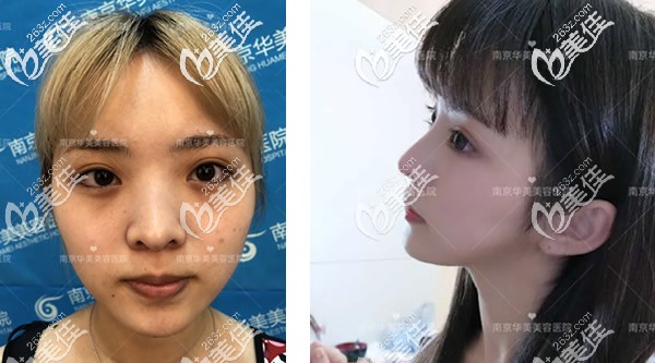 南京华美曹海峰鼻子案例 南京华美曹海峰鼻子案例