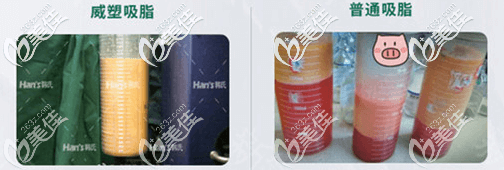 北京韩啸威塑吸脂术中脂肪情况示意图