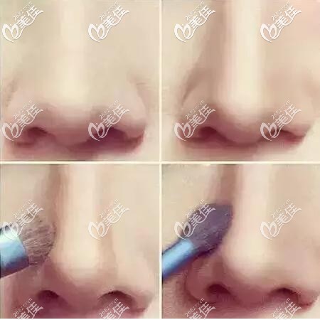 通过鼻影改变鼻型 通过鼻影改变鼻型