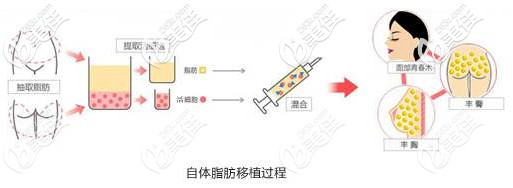 自体脂肪丰胸手术过程 自体脂肪丰胸手术过程