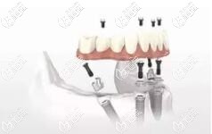 all-on-4微创即刻种植牙 all-on-4微创即刻种植牙