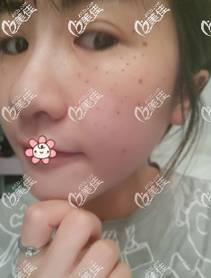 希望斑点快点下去