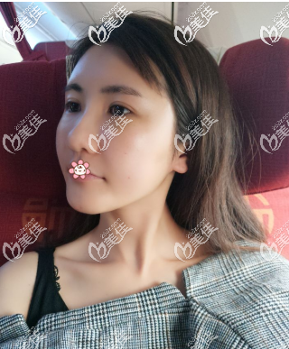 我在重庆时光整形做完皮秒祛斑一个月了