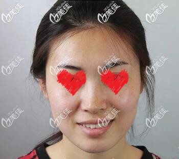 玻尿酸填充面部术前照 玻尿酸填充面部术前照