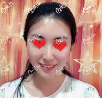 玻尿酸填充面部术后3天效果图 玻尿酸填充面部术后3天效果图