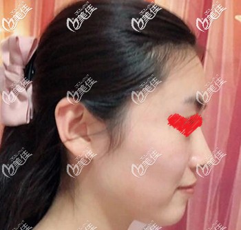 注射玻尿酸填充面部术后半个月效果图 注射玻尿酸填充面部术后半个月效果图