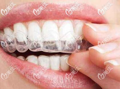 隐形牙套