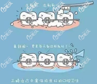 正畸保持口腔卫生
