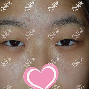 做手术前自己的肿泡眼 做手术前自己的肿泡眼