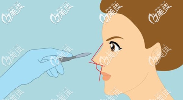 舒辟峰做鼻综合的技术优势