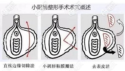小阴唇缩小手术的方法