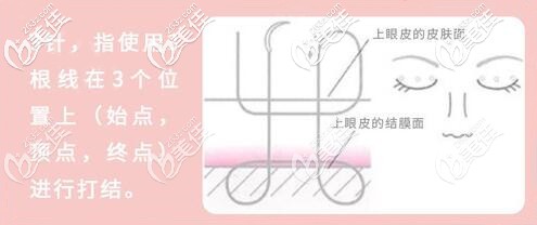 保志院长做定点双眼皮的手术原理 保志院长做定点双眼皮的手术原理