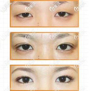 保志院长给出的真人案例术后效果 保志院长给出的真人案例术后效果