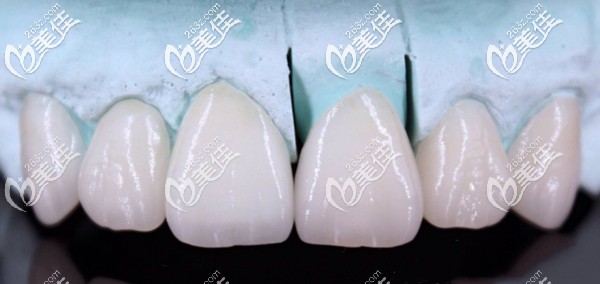 石膏工作模上做的铸瓷美学贴面