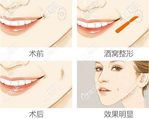埋线酒窝成形术原理 埋线酒窝成形术原理