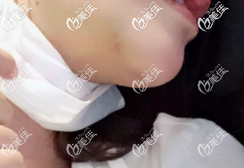 刚拆完线的下巴 刚拆完线的下巴