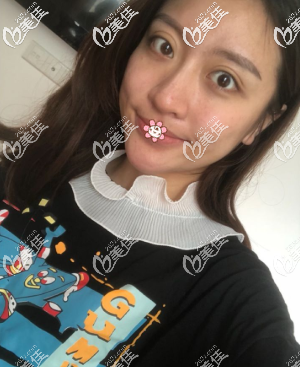 我在重庆好美做完硅胶垫下巴20天 我在重庆好美做完硅胶垫下巴20天