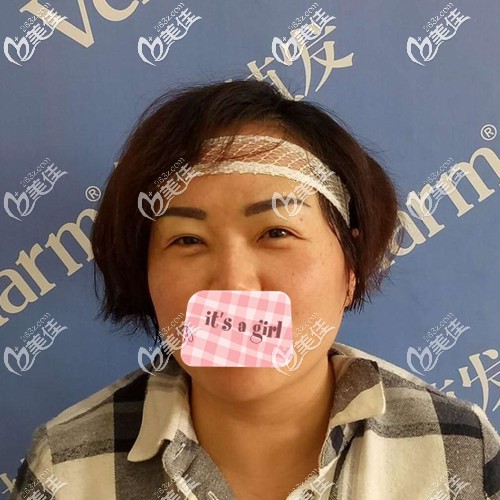 种植眉毛术后即刻效果 种植眉毛术后即刻效果