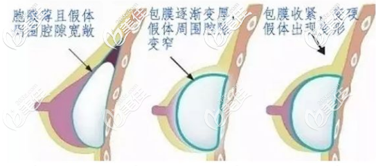 假体隆胸手术后包膜挛缩 假体隆胸手术后包膜挛缩
