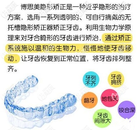 博思美隐形牙套的优势图