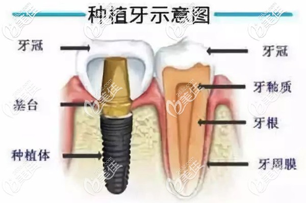 种植牙的结构示意图