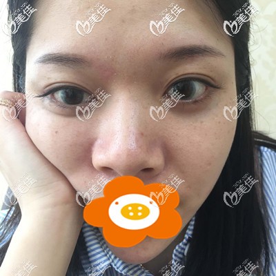 这是做隆鼻手术前的我 这是做隆鼻手术前的我