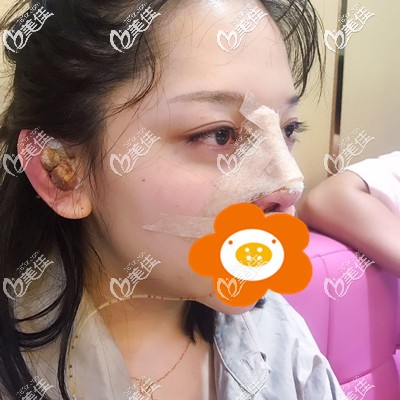 刚做完手术的丑样 刚做完手术的丑样