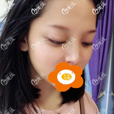 做完隆鼻手术后一周 做完隆鼻手术后一周