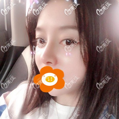 术后一个月打卡 术后一个月打卡