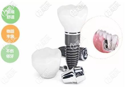 种植牙优势 种植牙优势