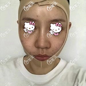 面部吸脂术后即刻戴着弹力面罩