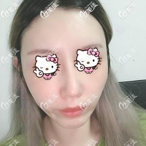 刚卸掉弹力面罩的手术效果