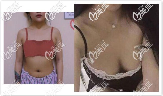 经历三次自体脂肪隆胸后效果图 经历三次自体脂肪隆胸后效果图