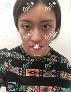 还没拆线 还没拆线