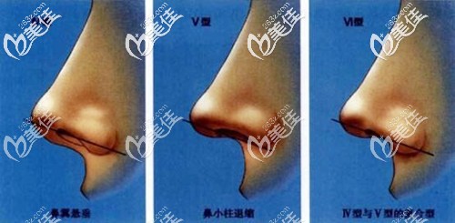 鼻小柱下垂的几种情况