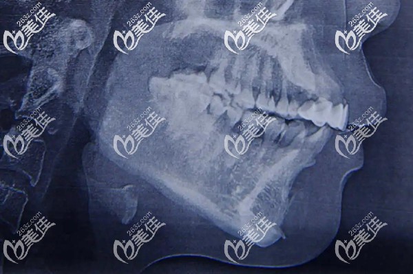 在广州光大口腔做正颌手术前CT片