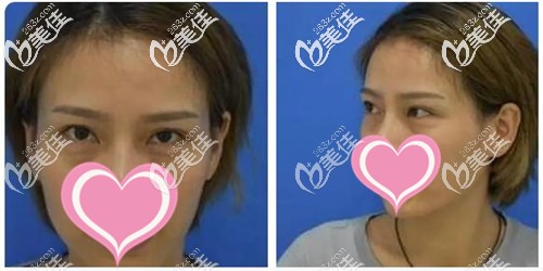 外切去眼袋手术前 外切去眼袋手术前