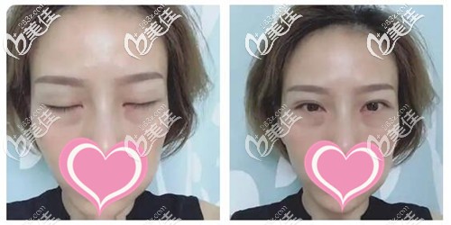 外切去眼袋手术后恢复三天照片 外切去眼袋手术后恢复三天照片