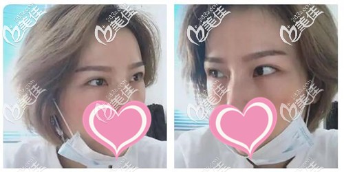 外切祛眼袋手术后7天照片 外切祛眼袋手术后7天照片